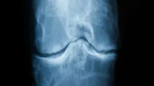 Röntgenaufnahme eines Knies mit Arthrose